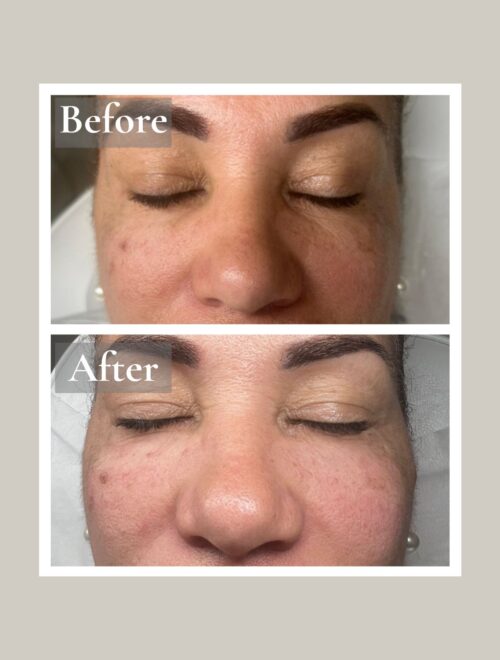 Cheek filler (2)