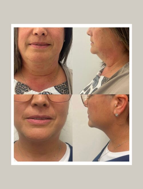 Kybella