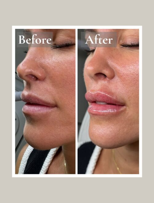 Lip Filler (2)