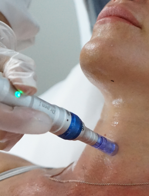 MICRONEEDLING