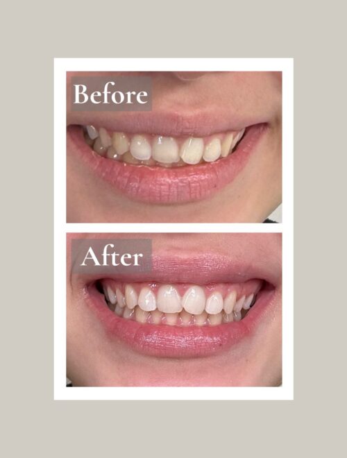 Teeth whitening